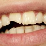 Chipped Tooth – Dream Meaning and Symbolism